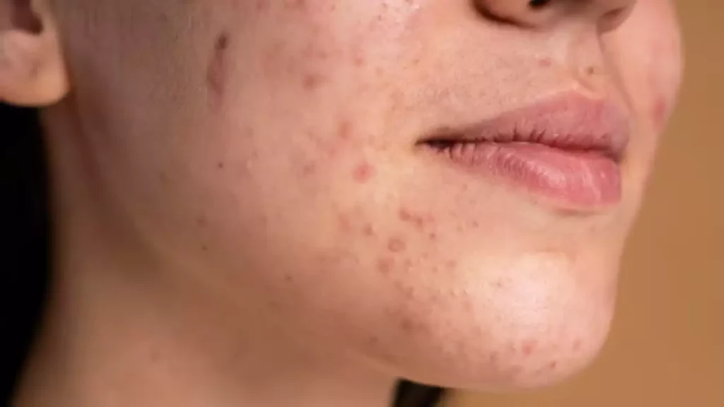 Can Ayurvedic Health Tips Help With Acne And Eczema